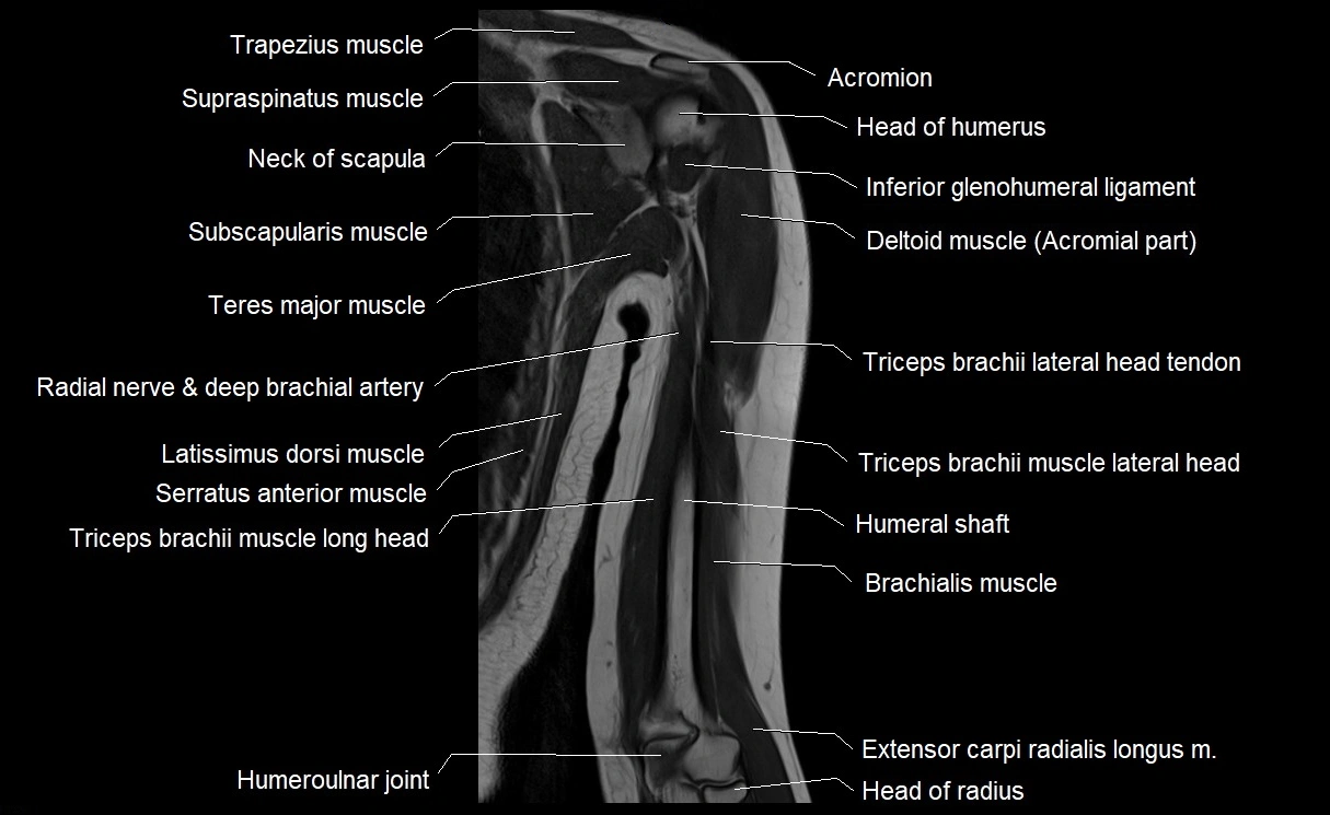MRI upper arm (humerus ) coronal cross sectional anatomy image 17.webp